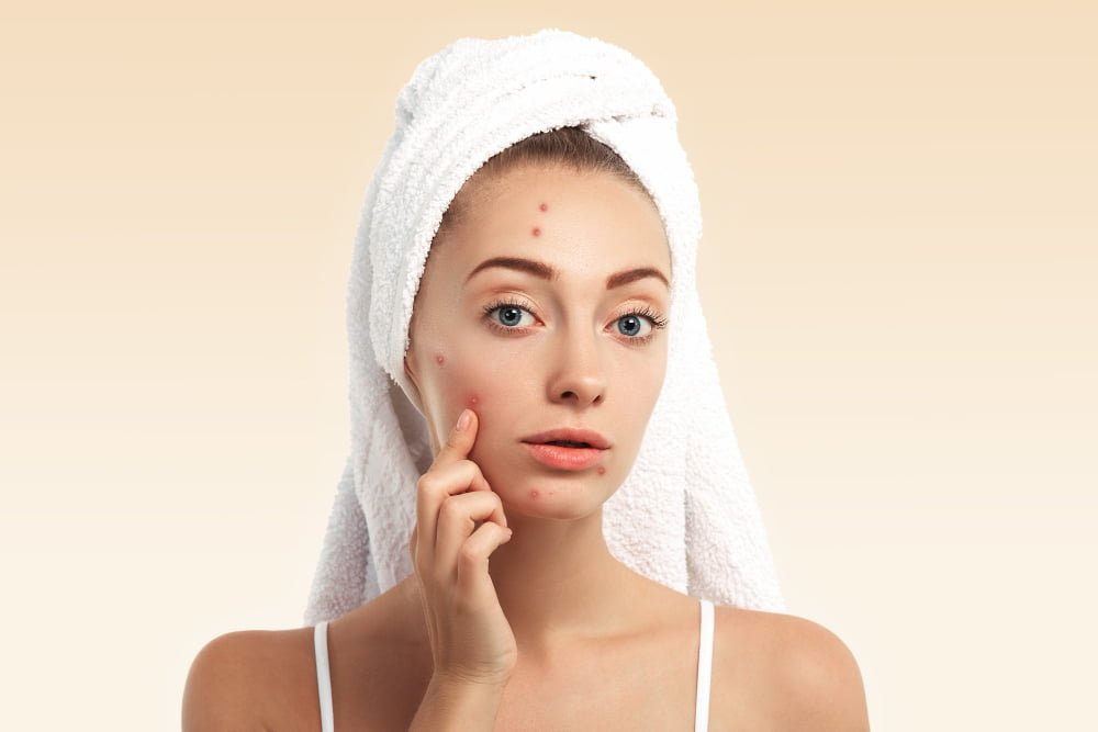 Acne (pimples): Causes, Symptoms, Treatment, Medicine and Ayurveda Home remedies.