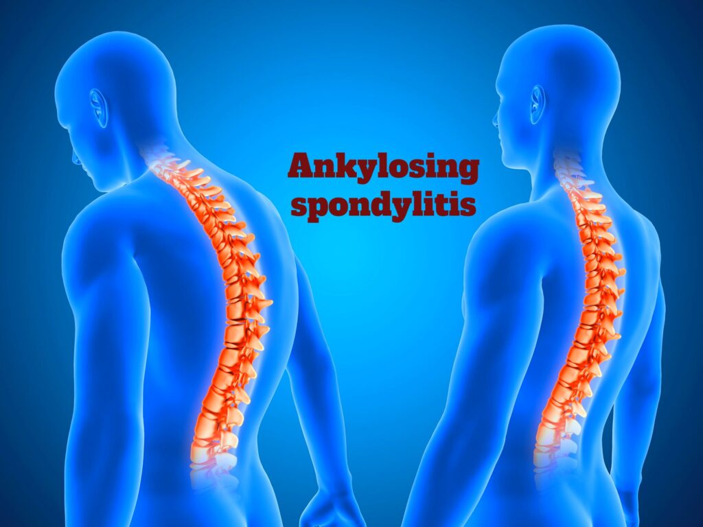 Ankylosing spondylitis photos. webhealthcares.com