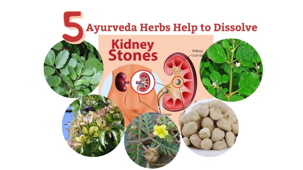 5 Effective Ayurveda Herbs Help to Dissolve Kidney Stone