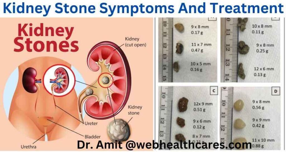 kidney stone photos, image