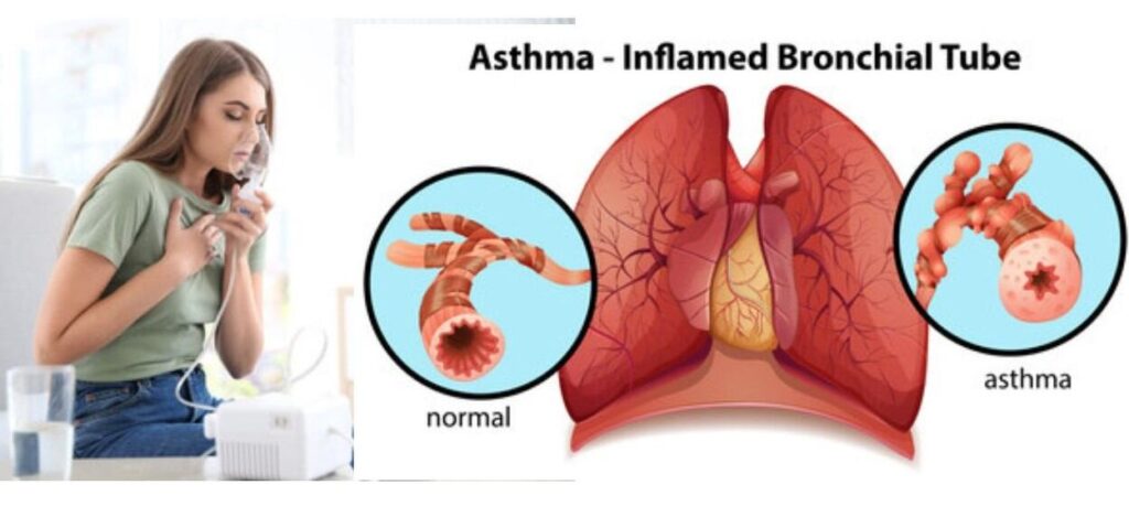Asthma : Symptoms, Test, Treatment, Avoid Food, Ayurveda Medicine.