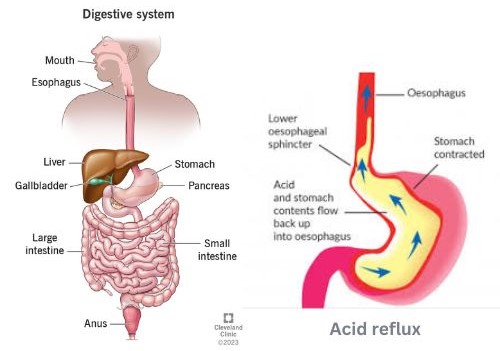 symptoms of acid reflux disease